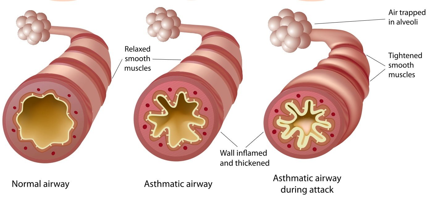 Asthmatic airway comparison